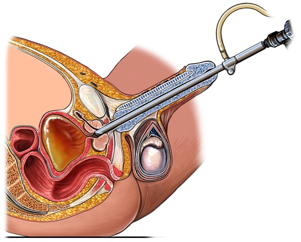 urinary kidney stone