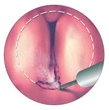 holep treatment image