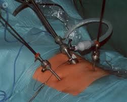 hernia repair surgery