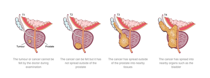 prostate cancer